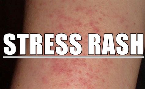 Stress Rash How To Identify And Treat Rashes Caused By Stress Otosection