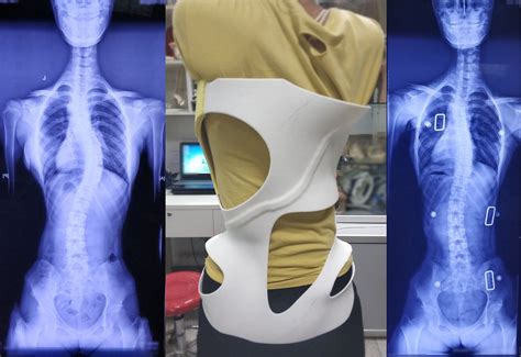 ‘smart 3d Printed Braces Could Improve Scoliosis Treatment