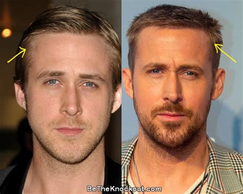 Ryan Gosling Plastic Surgery Comparison Photos