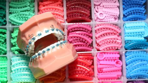 Guide On What Color Braces Should You Get Brownstone Dental