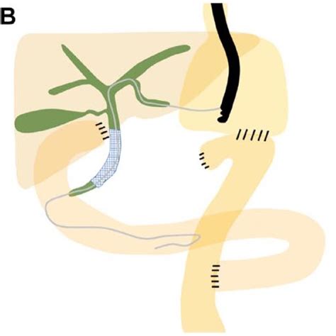 Study Outcomes Of Endoscopic Ultrasound Guided Biliary Drainage In