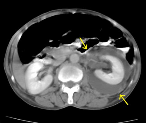 Perinephric Abscess Ct Sumers Radiology Blog