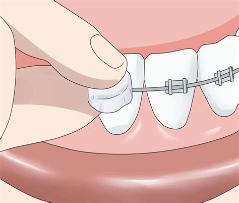 Orthodontic How To Apply Dental Wax On Braces Directorio Odontológico