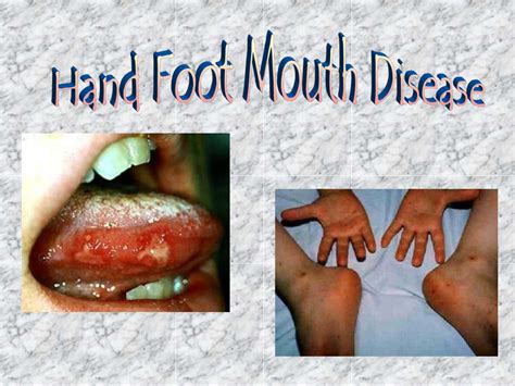 Ppt Hand Foot Mouth Disease Powerpoint Presentation Free Download