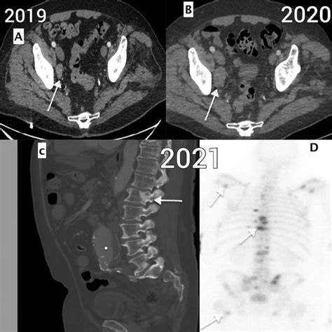 A Contrast Enhanced Ct Scan Axial Sections Done In 2019 It Shows