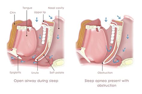 Upper Airway Resistance Syndrome Nyc Sleepwell
