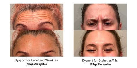 Botox Vs Dysport What S The Difference