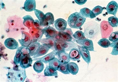 Lm Of Cervical Smear Chlamydia Infection Stock Image M8620034