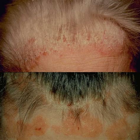 Natural Scalp Psoriasis Treatment With Tea Tree Oil And Olive Oil