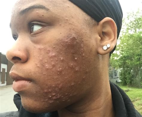 Skin Positivity Confronts Acne Stigma Whyy