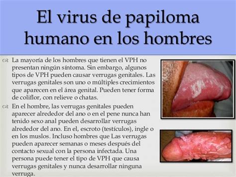 Infecciones Genitales Por El Virus Del Papiloma Humano Enfermedades