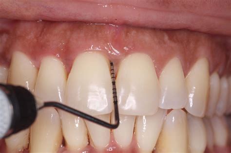 Diagnostico De Las Recesiones Gingivales Planeta Perio