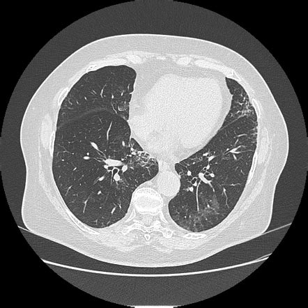 Exogenous Lipoid Pneumonia Radiology Reference Article Radiopaedia Org