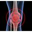 Do You Have Knee Pain Heres Two Important Things To Consider 