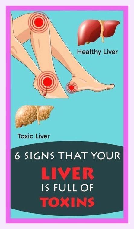 6 Signs That Your Liver Is Full Of Toxins Fatty Liver Liver Healthy