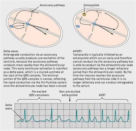 Termination Of Atrioventricular Nodal Reentrant Tachycardia By My Xxx