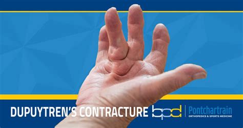 Understanding Dupuytrens Contractures Brandon P Donnelly Md