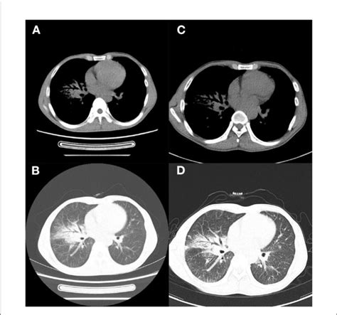 Figure Case E Ab Chest Ct T Months Later Showed Improved Lung