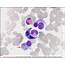 Plasma Cell Myeloma  CELL Atlas Of Haematological Cytology