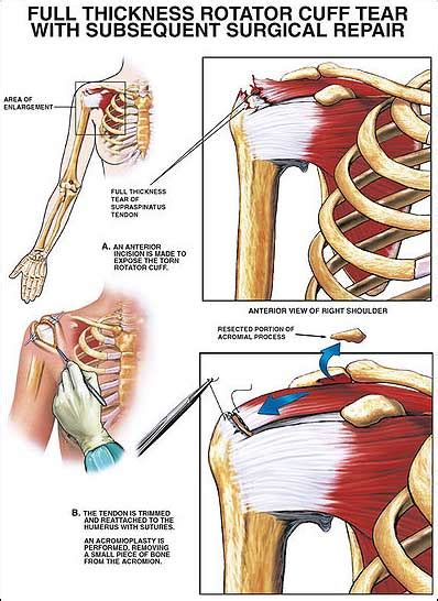 Rotator Cuff Injury Causes Symptoms Diagnosis Treatment