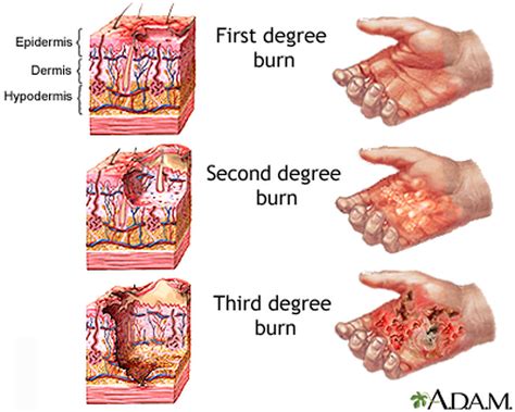 Explained Why Burn Wounds Are So Terrible