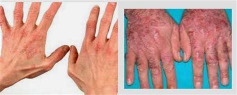 Bukan karena akan mendapat uang, berikut ini adalah beberapa kemungkinan penyebab telapak tanganmu terasa gatal. Penyakit Psoriasis: Gejala Psoriasis