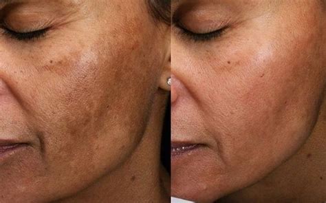Photofacial And Rf Microneedling 1 Tx By The Alabaster Doll In Phoenix