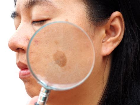 Antioxidant Drug Promising For Melasma Dermatology Times And