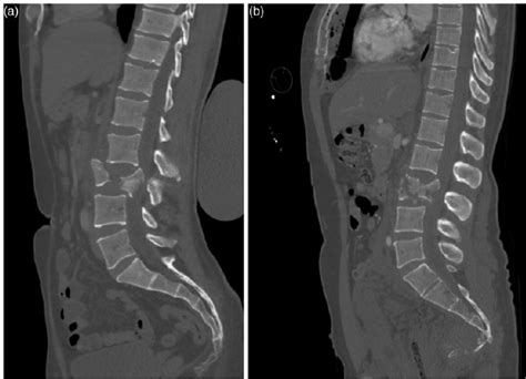 Another benefit of backbone is the ease of communicating with the server through ajax interactions. Spinal bone fractures. Visual impression of ASIR images ...