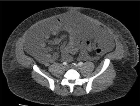 Figure 1 From Massive Ascites Following Robot Assisted Radical