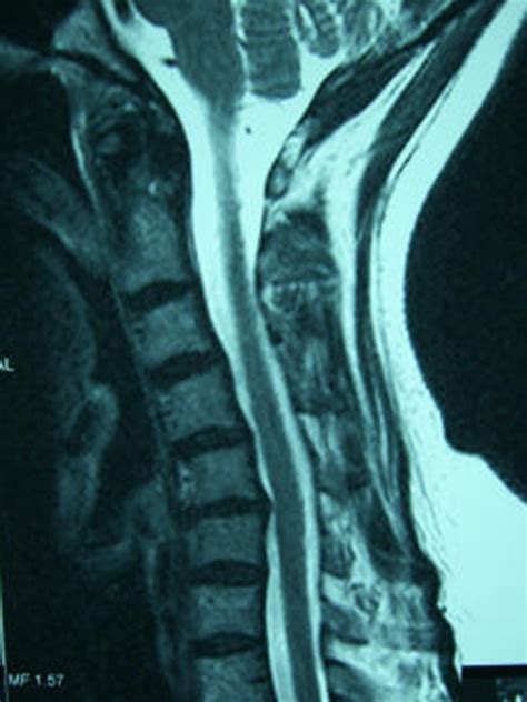 Anterior Cervical Fusion Reno Orthopedic Center