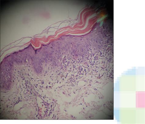 Figure 5 From Hyperkeratosis Lenticularis Perstans Case Report Of A