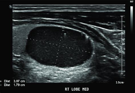 Ultrasound Of Thyroid Showed A Right Lobe Nodule Located At Mid To