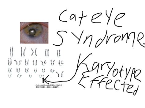John Martin Cat Eye Syndrome Science Showme