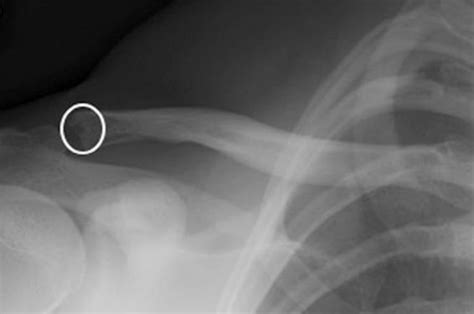 Distal Clavicle Osteolysis Shoulder And Elbow Orthobullets