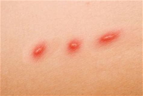 Urticaria also can cause red welts to appear on the skin. Cat Scratch Disease - Pictures, Symptoms, Treatment, Diagnosis