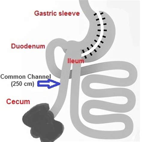 Schematic Demonstration Of Single Anastomosis Sleeve Ileal Sasi