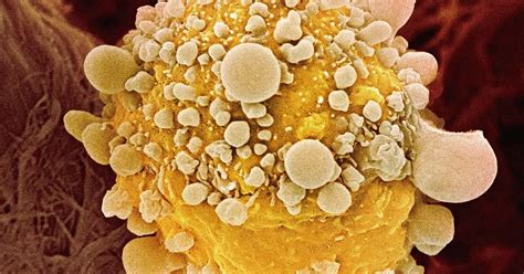 Cancer Tumours Could Be Starved To Death After Scientists Discover How