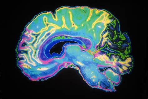 Schizophrenia And Alzheimer’s Disease Risk Linked To Brain Inflammation