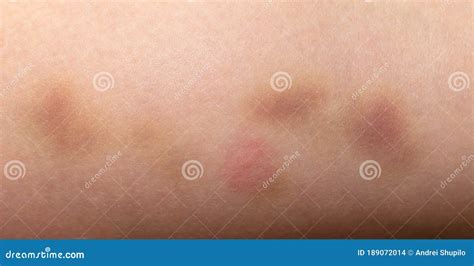 Closeup On A Bruise On Wounded Woman Leg Skin Close Up On A Bruise On