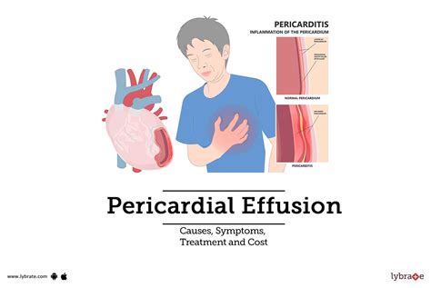 Pericardial Knock What Is It Causes Treatment And Mor