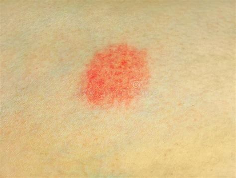 Skin Disease Stock Photo Image Of Acne Epidermis Burning 32518320