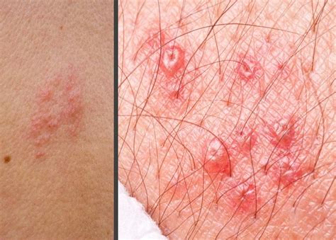 Pictures Of Skin Rashes Lovetoknow Health And Wellness Skin Rash