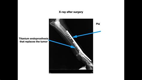 Limb Sparing Surgery In Dogs With Bone Cancer Youtube