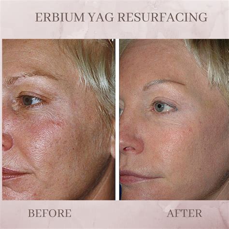 Erbium Skin Resurfacing Eluma Laser And Aesthetics