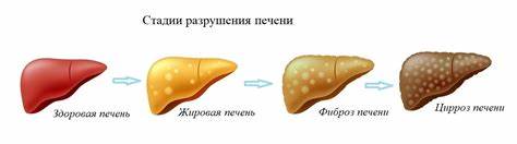Диета стеатоз поджелудочной