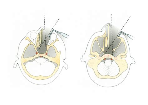 Anterior Approaches To Clivus Skull Base Surgery Atlas