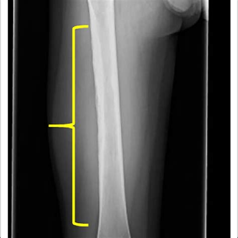 Frontal Radiograph Of The Right Femur Obtained For Swelling
