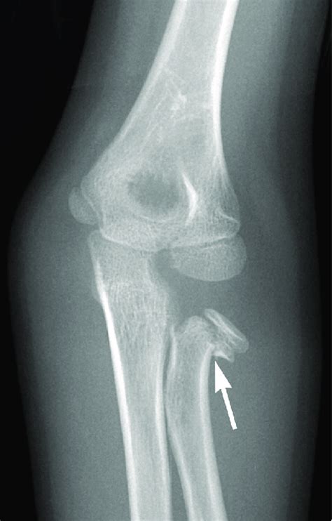 Radial Head Fracture The Anteroposterior View Shows The Type 2