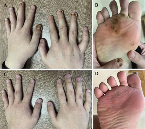 Treatment Of Multiple Plantar And Periungual Warts In The Patient With